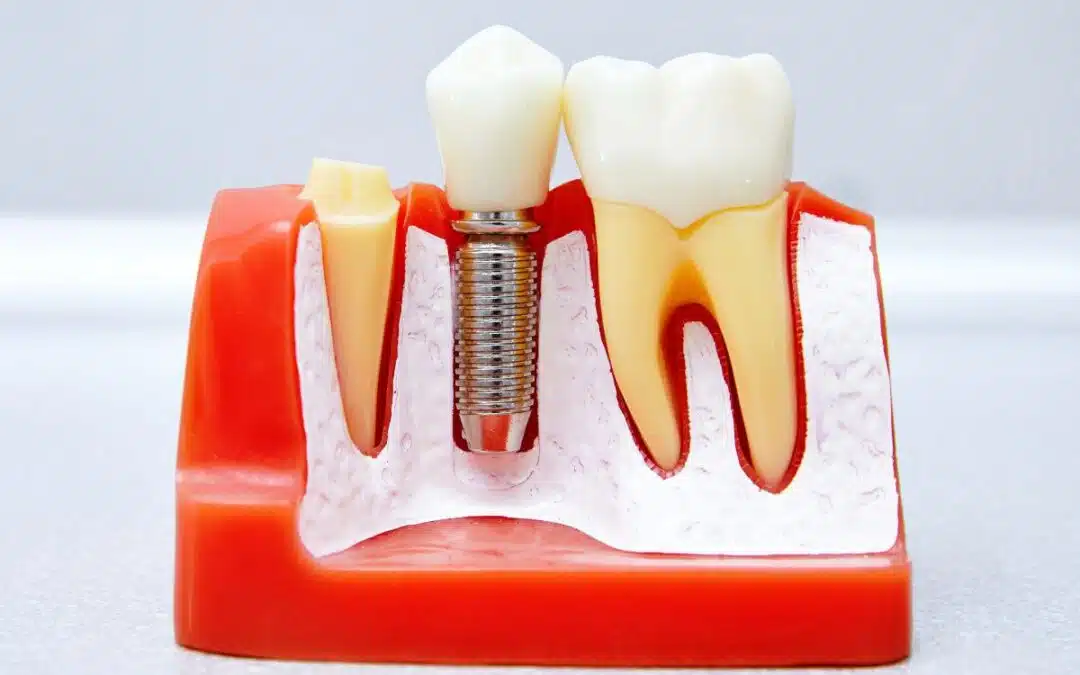 dental implants houston